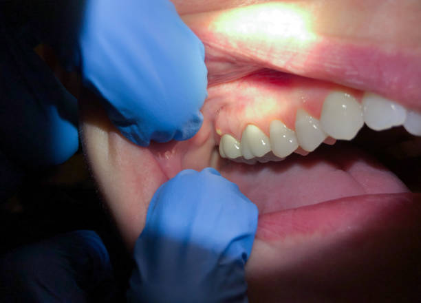 Best Emergency Dentist for Lost Fillings or Crowns in Adamsville, TN